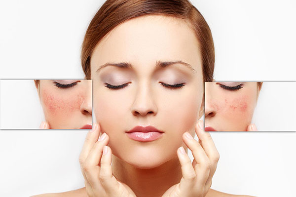 cách chăm sóc da mặt mỏng và nhạy cảm, chăm sóc da mặt mỏng và nhạy cảm, da mặt mỏng và nhạy cảm, da mỏng và nhạy cảm
