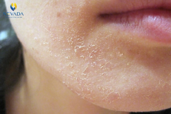nguyên nhân da bị khô, nguyên nhân gây khô da, nguyên nhân da mặt bị khô, nguyên nhân khiến da mặt bị khô, nguyên nhân da mặt khô, vì sao da mặt bị khô, nguyên nhân gây khô da mặt, hiện tượng da mặt bị khô, nguyên nhân bị khô da